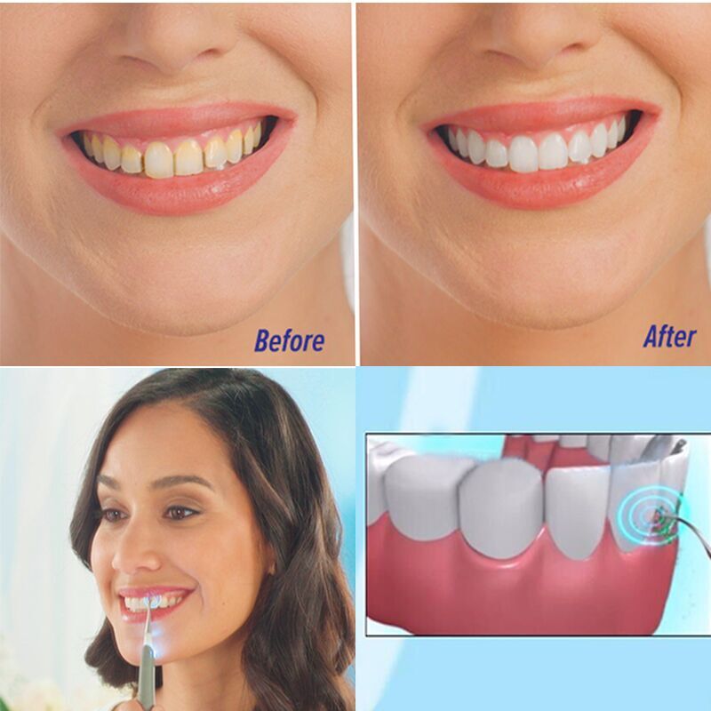 Sonic Dental Scaler: Electric Teeth Whitening Tool